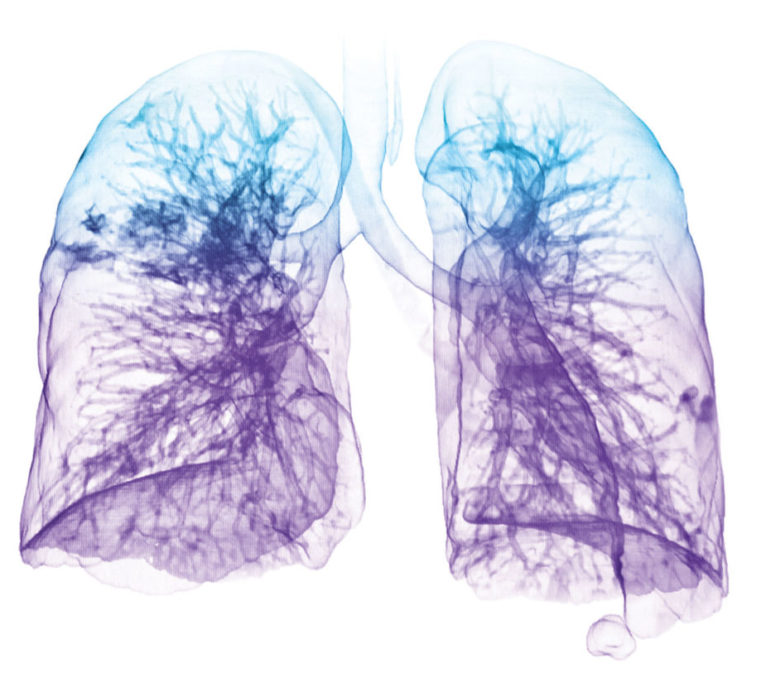 Lung-Health-Valve-Zephyr