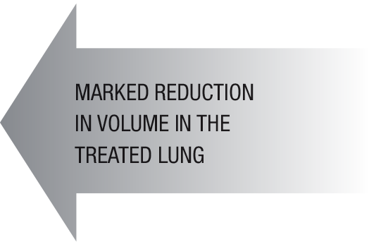 Marked-Reduction-Lung-Volume-COPD