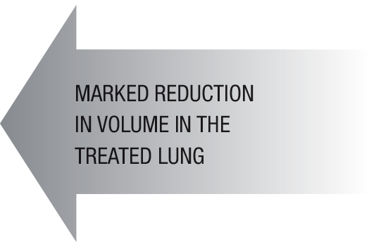 Marked-Reduction-Lung-Volume-COPD Marked-Reduction-Lung-Volume-COPD