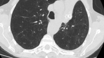 Seides-62-year-old-female-Marked-Lung-Volume-Reduction