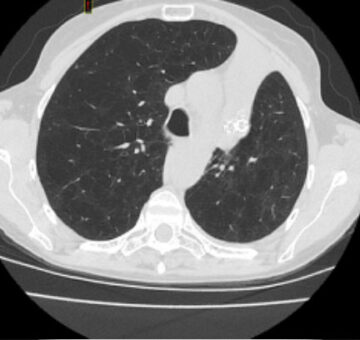 Seides-62-year-old-female-Marked-Lung-Volume-Reduction