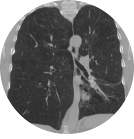 55yo-lung-Post-CW-clinical-spotlight