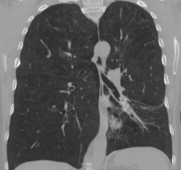 Post-Zephyr-Clinical-Spotlight-55-female