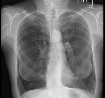 Pre-Treatment-65yofemale