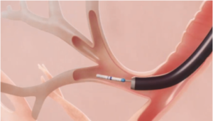 How Zephyr Works - Pulmonx