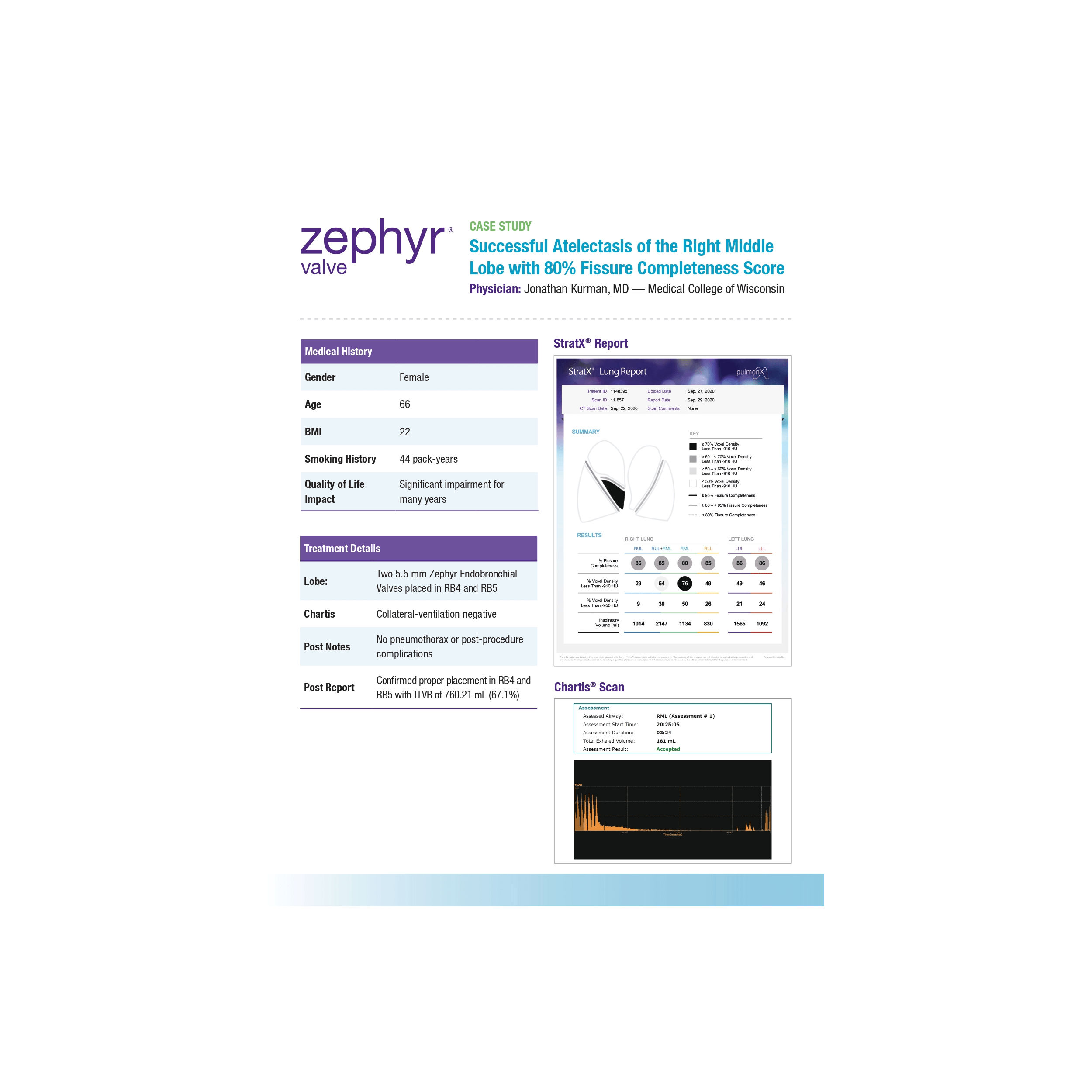Successful atelectasis of the right middle lobe with 80 fissure completeness score_page-0001 (1)